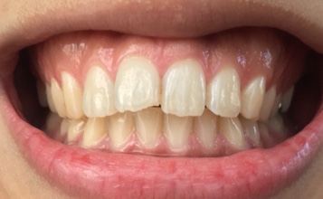 前歯部叢生　治療前写真2