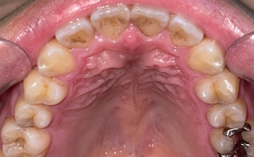 前歯部叢生　治療前写真4