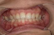 前歯部叢生　治療前写真1