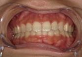 前歯部叢生　治療前写真4