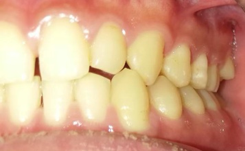 空隙歯列を伴う叢生　治療前写真3