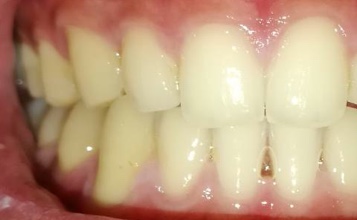 空隙歯列を伴う叢生　治療前写真4