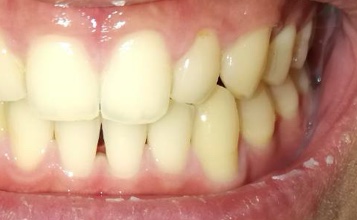 空隙歯列を伴う叢生　治療前写真6