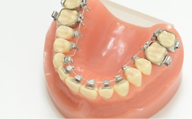 裏側矯正（舌側矯正）