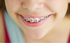 こどもの矯正（小児矯正）