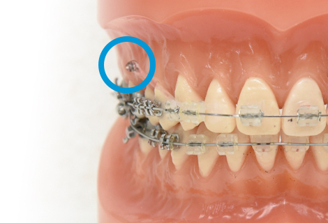 インプラント矯正