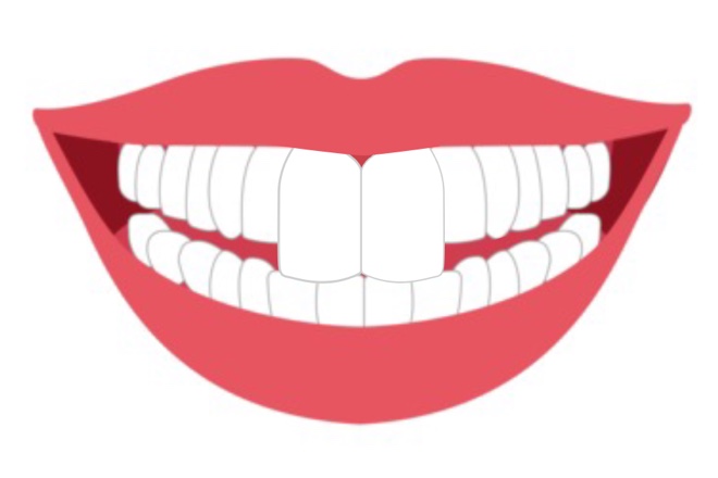 出っ歯イラスト