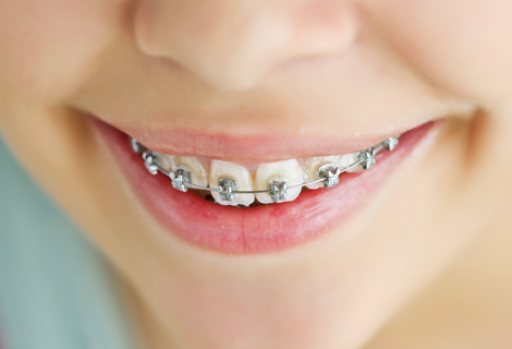 こどもの矯正（小児矯正）